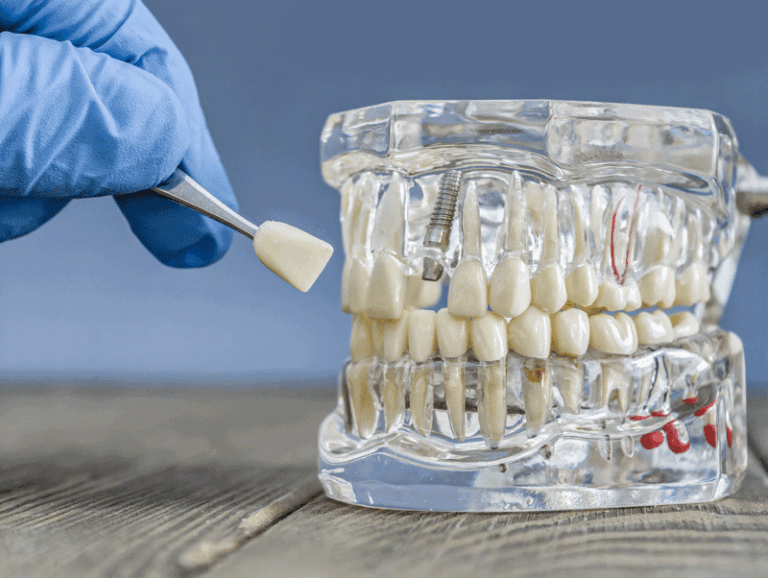 Detailed-Transparent-Dental-Implant-Model