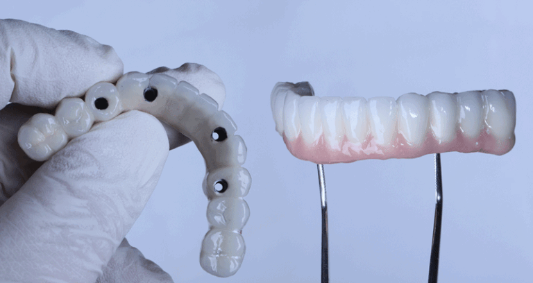 Full arch porcelain dental prosthesis on only 4 implants for completely edentulous jaws in dental jaw surgery and dentistry